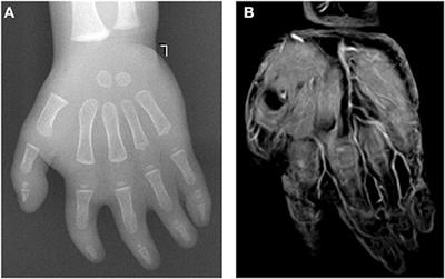 Preoperative MRI Evaluation of Hand Vessels in Children With Congenital Syndactyly Malformation by a Contrast-Enhanced Three-Dimensional Water-Selective Cartilage Scan